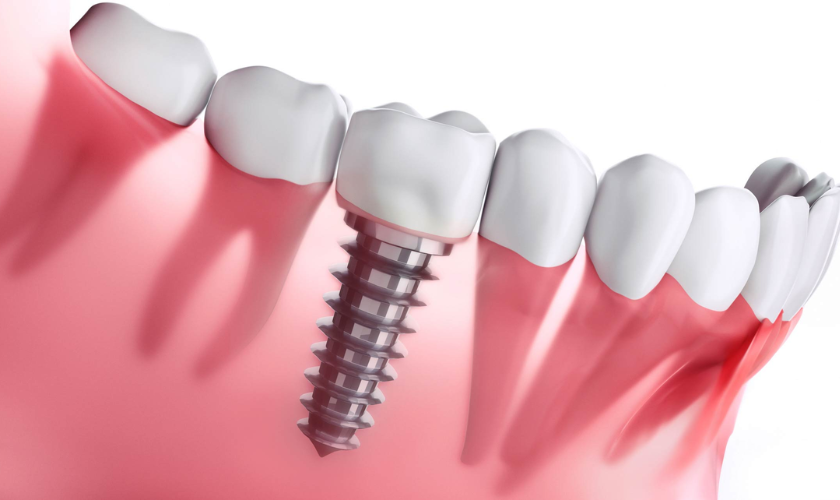 Mistakes to Avoid When Getting Dental Implants