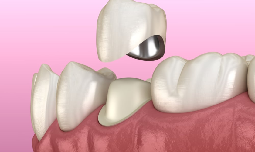 Dental Crowns On Self-Esteem