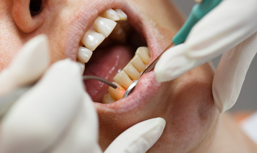 Benefit from Periodontal Therapy