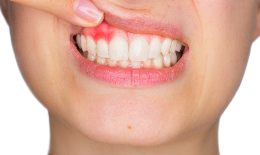 Preventing Gum Disease