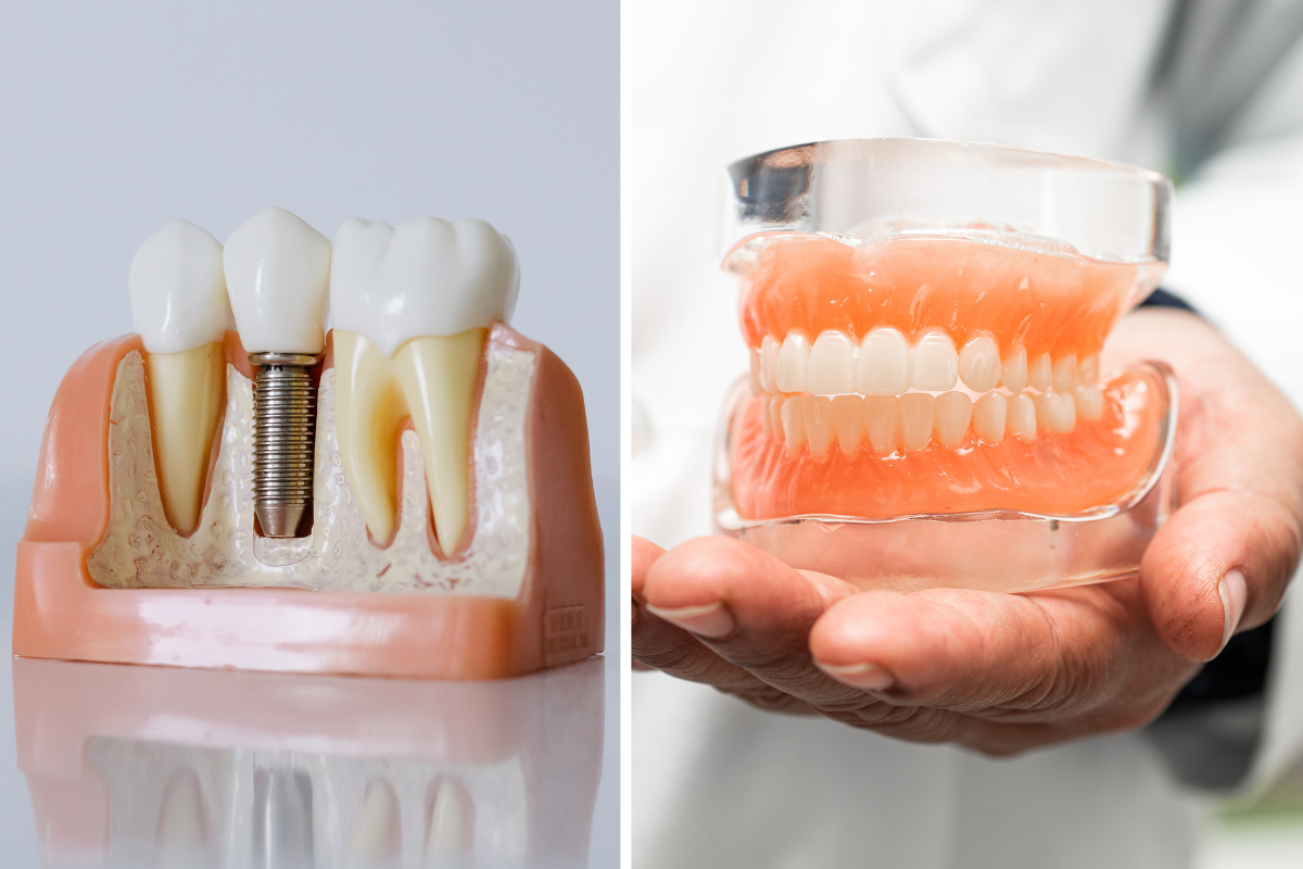 Dental Implants Vs Denture