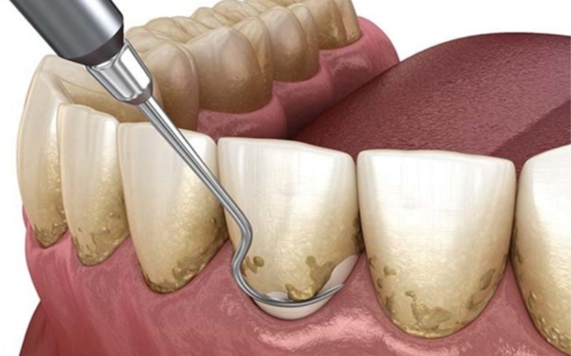 Why Scaling & Root Planing Are The Top Treatment for Gum Disease