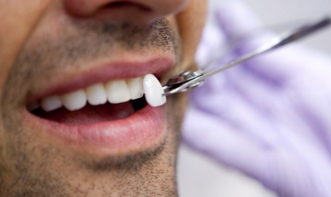 How Can Porcelain Veneers Modernize Your Smile