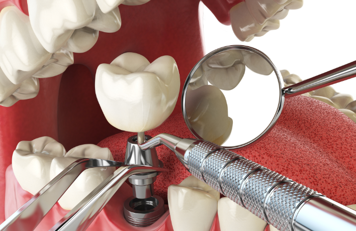 Are You A Candidate For Dental Implants? Common Eligibility Criteria