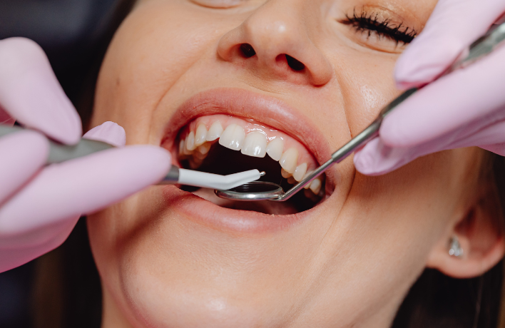 How Long Does Bonding Last On Teeth?