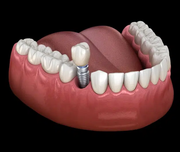 What Are Dental Implants?
